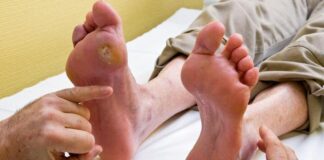 Diyabetik ayak enfeksiyonu nedir, belirtileri neler? Nasıl tedavi edilir?