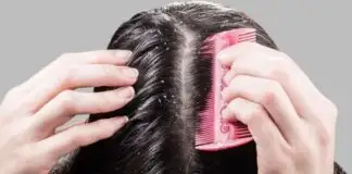 Saçta kepeklenme neden olur? Kepekli saçlar için Saraçoğlu kürü