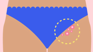 Bikini bölgesindeki kıl kökü iltihabı nasıl geçer?
