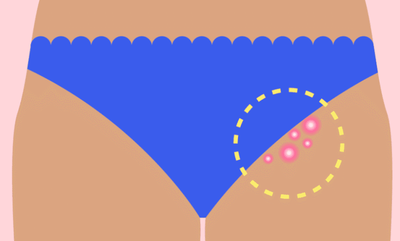 Bikini bölgesindeki kıl kökü iltihabı nasıl geçer?