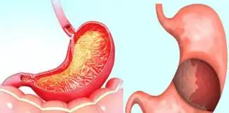 Gastrit mide duvarını kalınlaştırır mı? Saraçoğlu tedavisi
