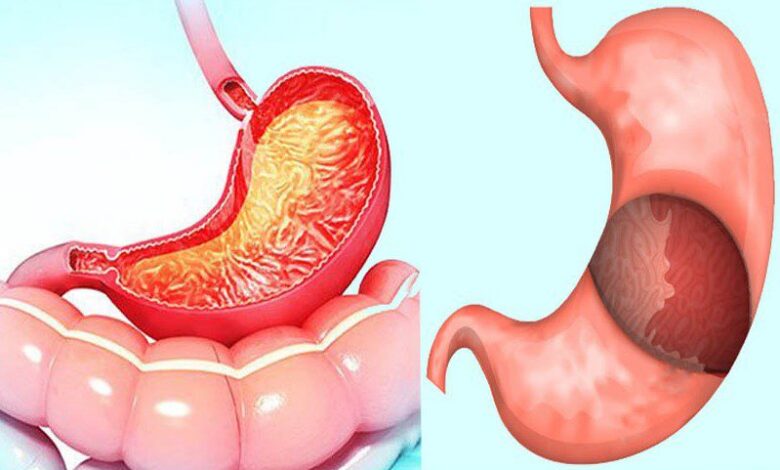 Gastrit mide duvarını kalınlaştırır mı? Saraçoğlu tedavisi 1 Gastrit mide duvarını kalınlaştırır mı? Saraçoğlu tedavisi