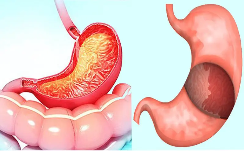 Gastrit mide duvarını kalınlaştırır mı? Saraçoğlu tedavisi 56 Gastrit mide duvarını kalınlaştırır mı? Saraçoğlu tedavisi