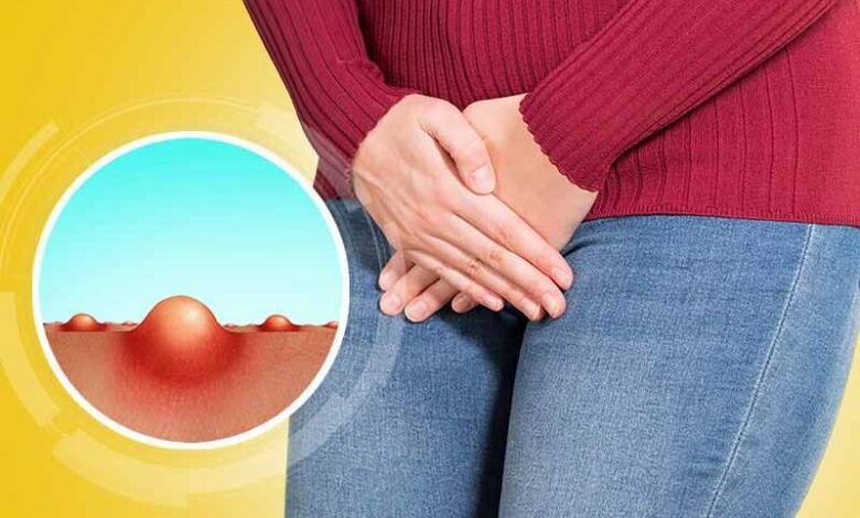 Genital bölgede sivilce doğal çözüm, bitkisel tedavi 1 Genital bölgede sivilce doğal çözüm, bitkisel tedavi