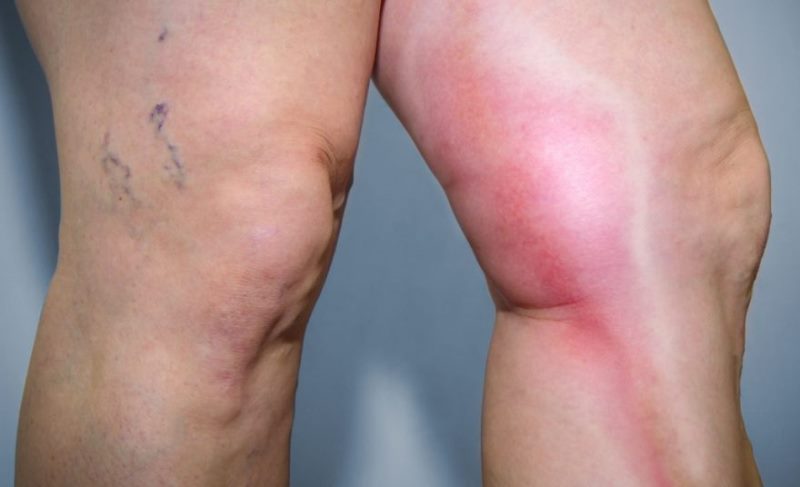 Bacak ağrısı neden olur, neyin belirtisi?