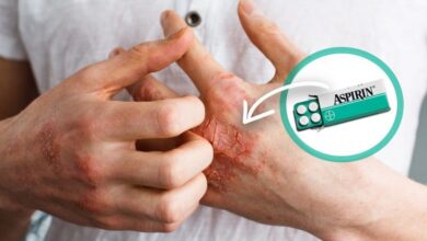 Egzamaya aspirin iyi gelir mi? Aspirinle egzama tedavisi