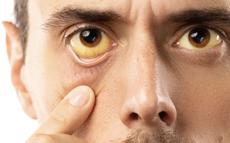 Gilbert sendromu nedir, nasıl oluşur, belirtileri nelerdir?