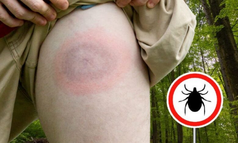 Lyme hastalığı belirtileri, sebepleri ve tedavisi 1 Lyme hastalığı belirtileri, sebepleri ve tedavisi
