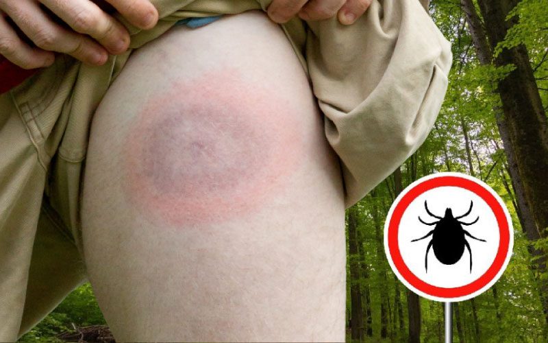 Lyme Hastaligi Belirtileri Sebepleri Ve Tedavisi Saglik Haberleri