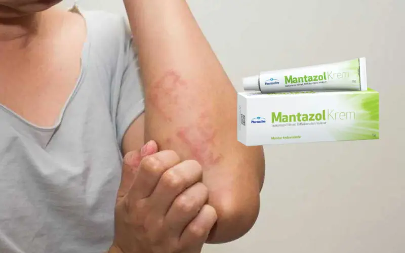 Mantazol krem vajinal mantara, pişiğe, egzamaya iyi gelir mi? 20 Mantazol krem vajinal mantara, pişiğe, egzamaya iyi gelir mi?