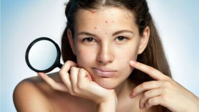 Yüzdeki sivilce lekeleri nasıl geçer? Krem ve maske önerileri