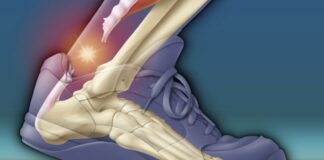 Aşil tendonu kopması belirtileri neler? Saraçoğlu tedavisi
