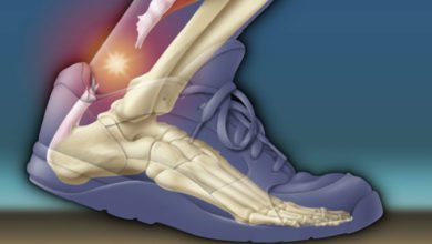 Aşil tendonu kopması belirtileri neler? Saraçoğlu tedavisi