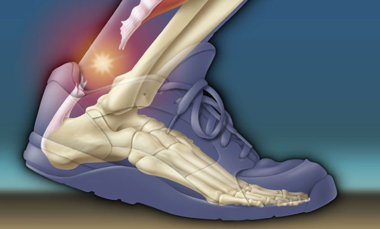 Aşil tendonu kopması belirtileri neler? Saraçoğlu tedavisi