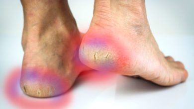 Topuk çatlağına hangi krem iyi gelir?