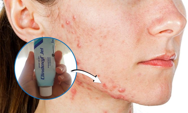 Clindoxyl jel sivilce lekelerine, izlere iyi gelir mi?