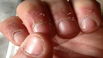 Tırnak eti soyulması vitamin eksikliği belirtisi mi?