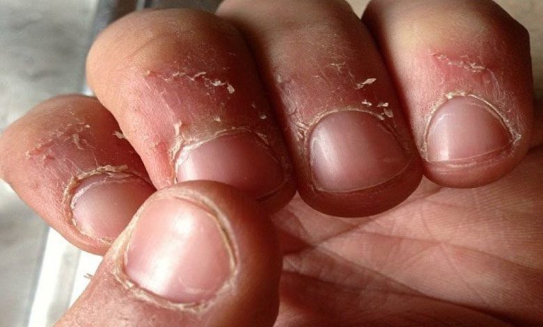 Tırnak eti soyulması vitamin eksikliği belirtisi mi?