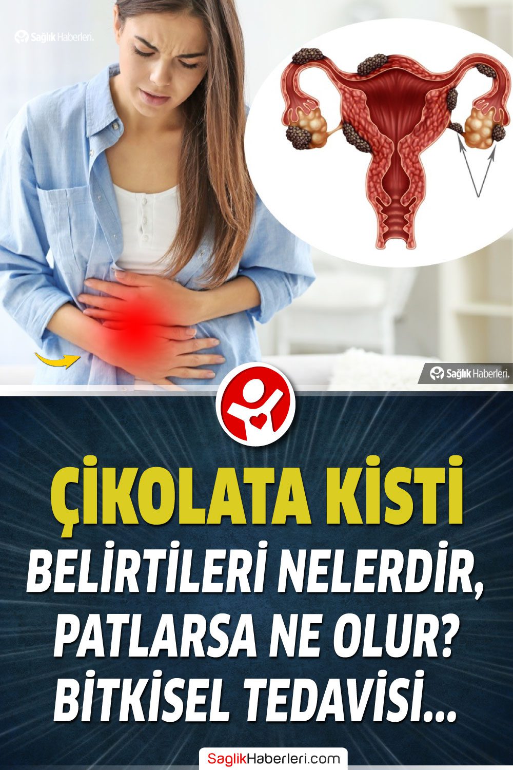 Çikolata kisti patlaması nasıl anlaşılır, patlarsa ne olur?