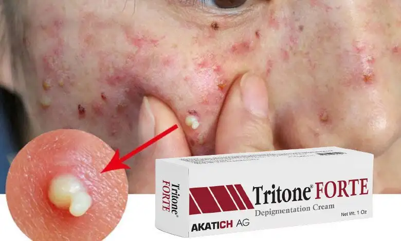 Tritone Forte krem sivilceye iyi gelir mi? İçeriği nedir?