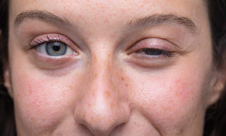 Myastenia gravis nedir, belirtileri nelerdir?