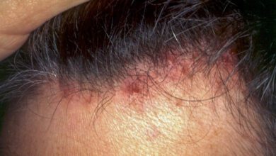 Kafada sivilce neden çıkar, ne iyi gelir, nasıl geçer?