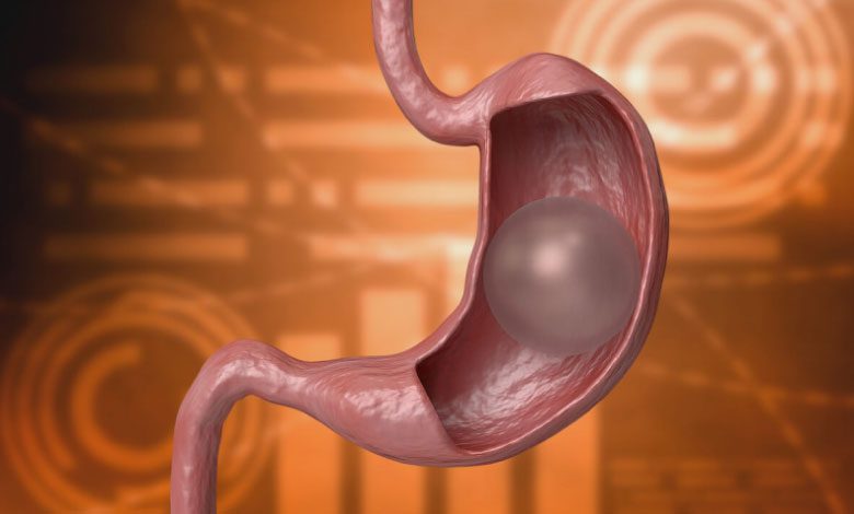 Mide balonu patlarsa ne olur?