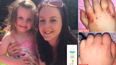 Doktorların tedavi edemediği egzamanın çaresini raflarda buldu