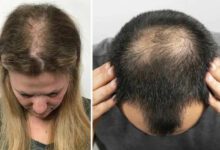 Seyrek saçlar için ne yapılmalı, gürleştirmek için şampuan önerileri