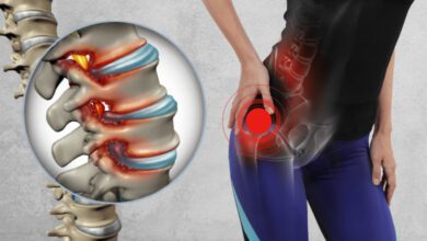 Belden, kalçadan bacağa vuran fıtık ağrısı nasıl geçer?