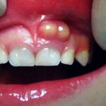 Diş apsesi kaç güne geçer, patlatmak zararlı mı? Tedavisi