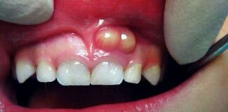 Diş apsesi kaç güne geçer, patlatmak zararlı mı? Tedavisi