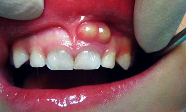 Diş apsesi kaç güne geçer, patlatmak zararlı mı? Tedavisi