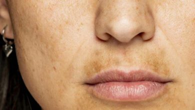 Bıyık bölgesi kararması neden olur, evde nasıl geçer?