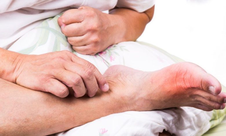 Gut hastalığı nedir, neden olur? Gut hastalığı tedavisi