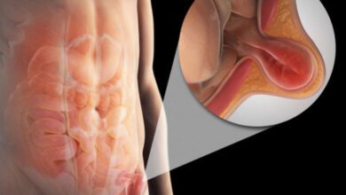 Kadınlarda kasık fıtığı neden olur, belirtileri neler?