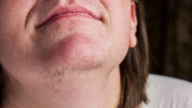 Kadınlarda tüylenme neden olur, hangi doktora gidilmeli?