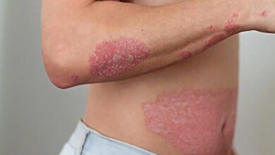 Sedef hastalığı bulaşıcı mı, cinsel yolla bulaşır mı?