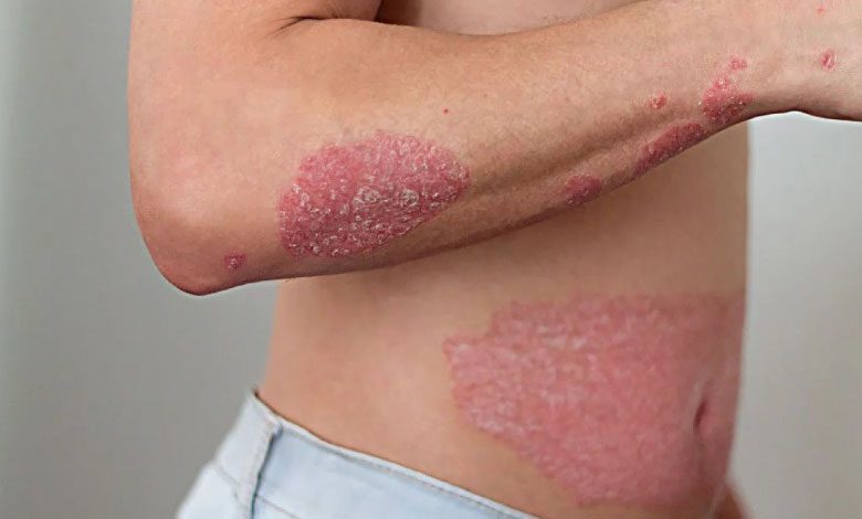 Sedef hastalığı bulaşıcı mı, cinsel yolla bulaşır mı?