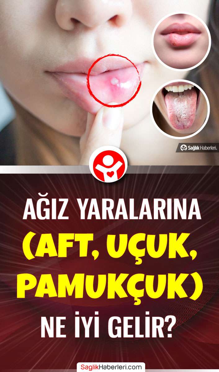 Ağız yaralarına (Aft, pamukçuk ve uçuk) ne iyi gelir?