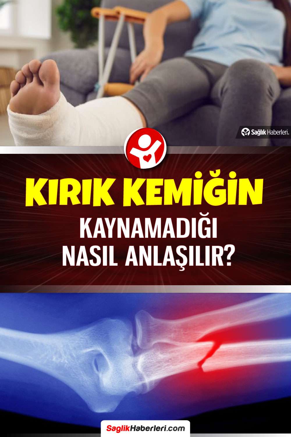 Kırık kemiğin kaynamadığı nasıl anlaşılır, belirtileri neler?