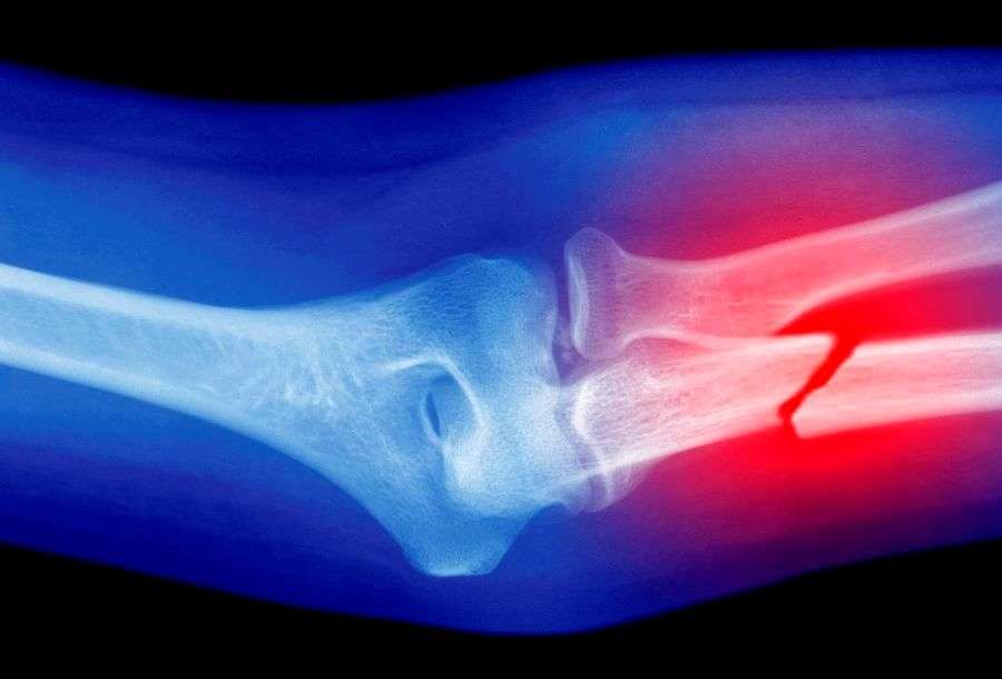 Kırık kemiğin kaynamadığı nasıl anlaşılır, belirtileri neler?