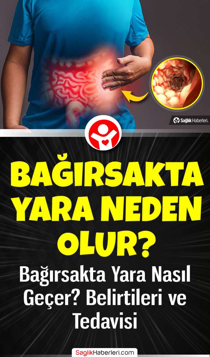 Bağırsakta yara neden olur, nasıl geçer? Belirtileri