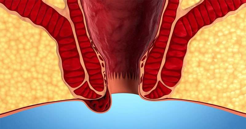 Hemoroidi önlemenin ve tedavi etmenin doğal yolları