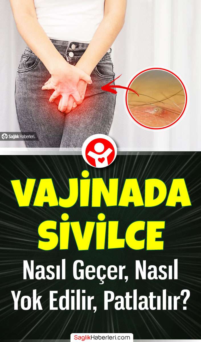 Vajinada sivilce nasıl geçer evde? Nasıl yok edilir, patlatılır?
