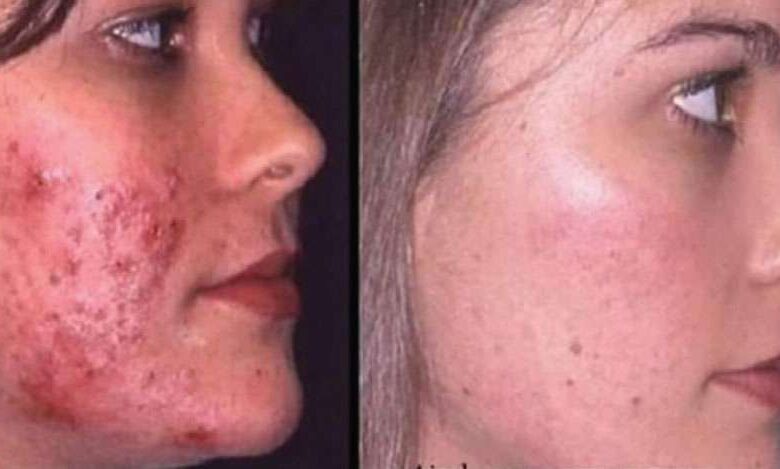 Acnelyse krem lekeleri geçirir mi, cildi beyazlatır mı?