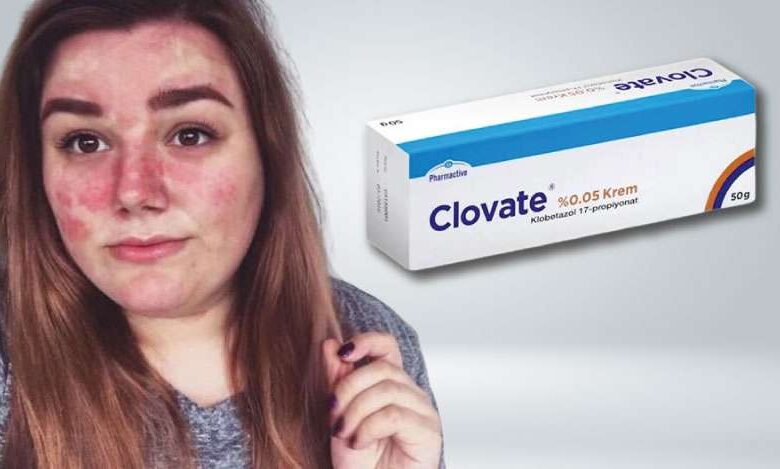 Clovate krem sivilceye iyi gelir mi, yüze sürülür mü?