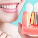 İmplant nedir? Diş implantı tedavisi kimlere uygulanır?