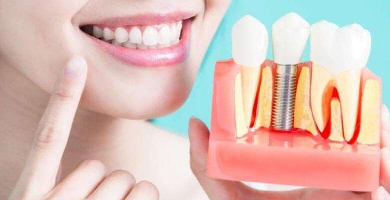 İmplant nedir? Diş implantı tedavisi kimlere uygulanır?