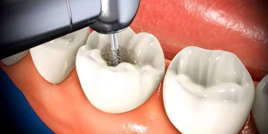 Kanal Tedavisi Nedir, Nasıl Uygulanır?